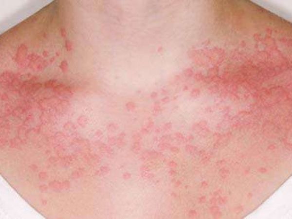 Симптомы аллергии от глистов, какие паразиты могут ее вызывать