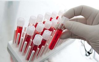 Как сдавать анализы крови на лямблии и его расшифровка