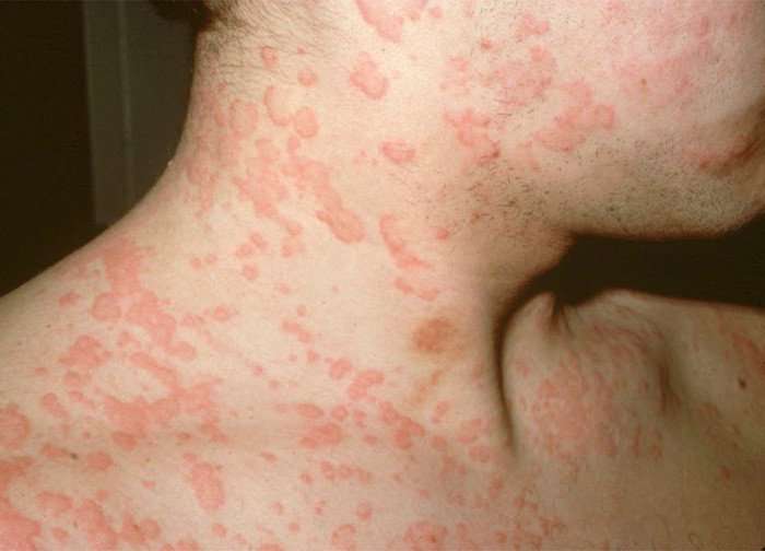 какие паразиты вызывают аллергию