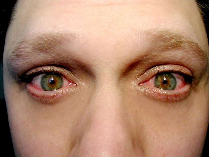 Демодекс глаз симптомы и лечение 70