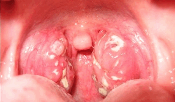 хламидии в горле