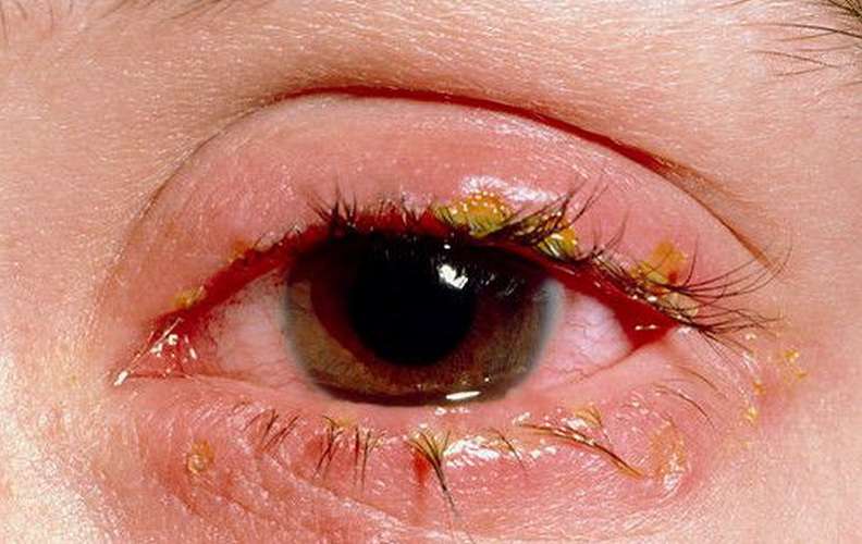 Демодекс глаз симптомы и лечение 74