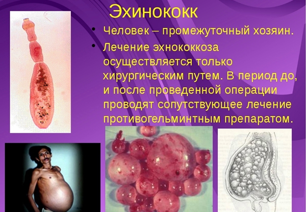 факты о эхинококкоз человека