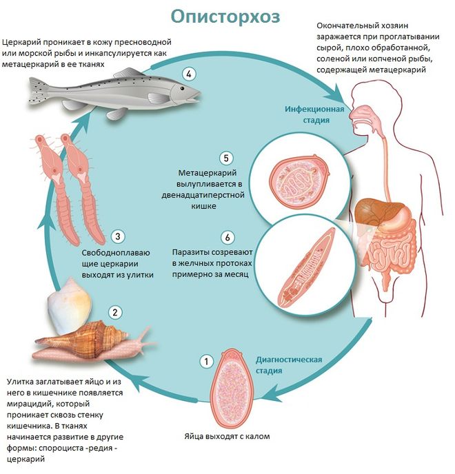 Описторхоз